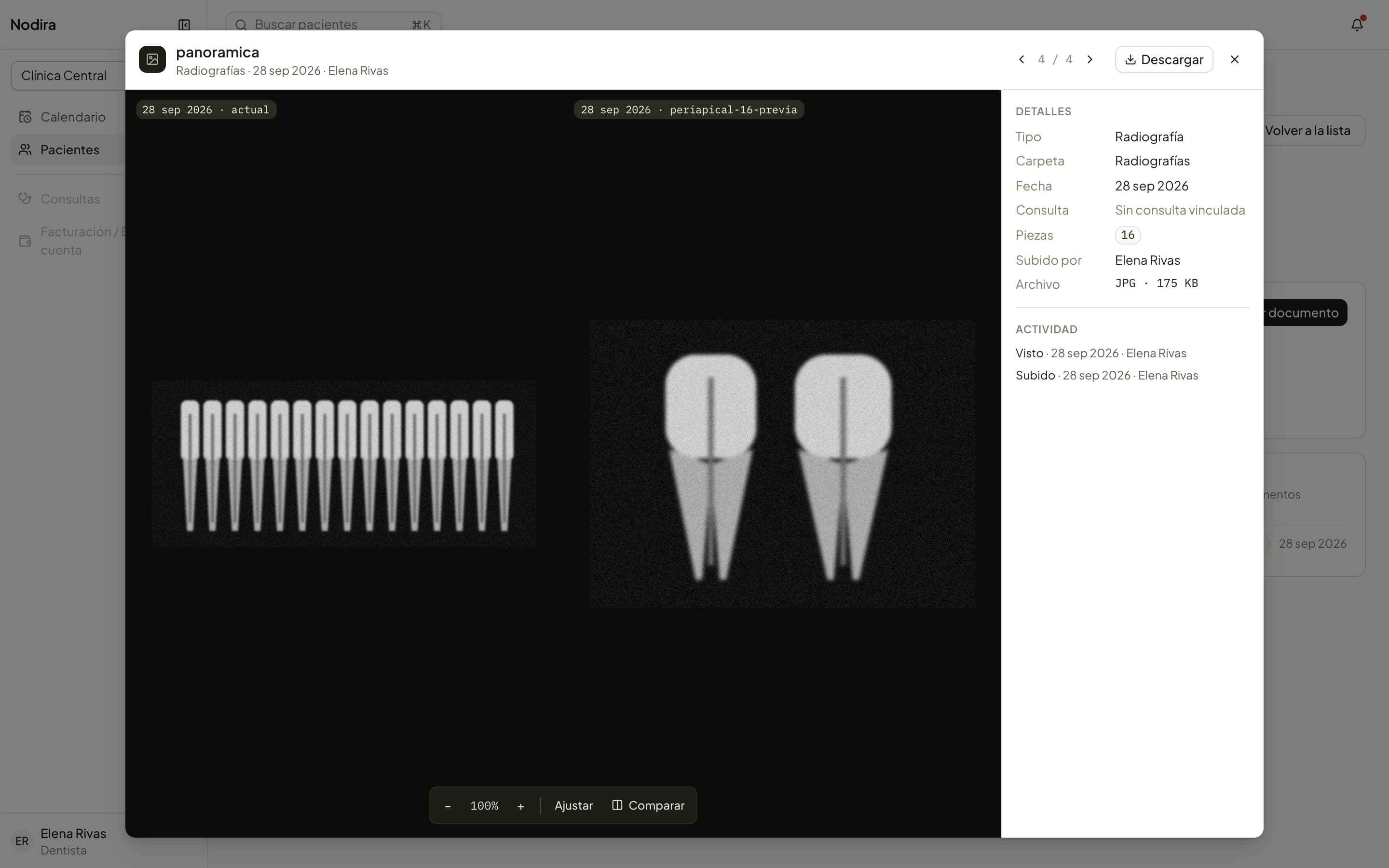 Two X-rays of the same tooth compared side by side.